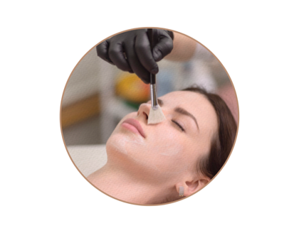 CHEMICAL PEELS before and after care