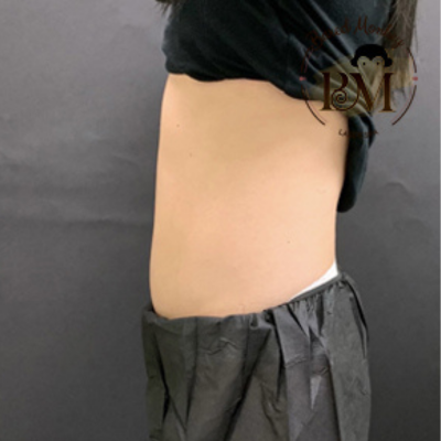 After EmSculpt treatment