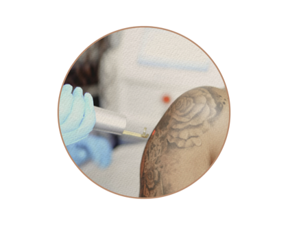 TATTOO REMOVAL before and after care